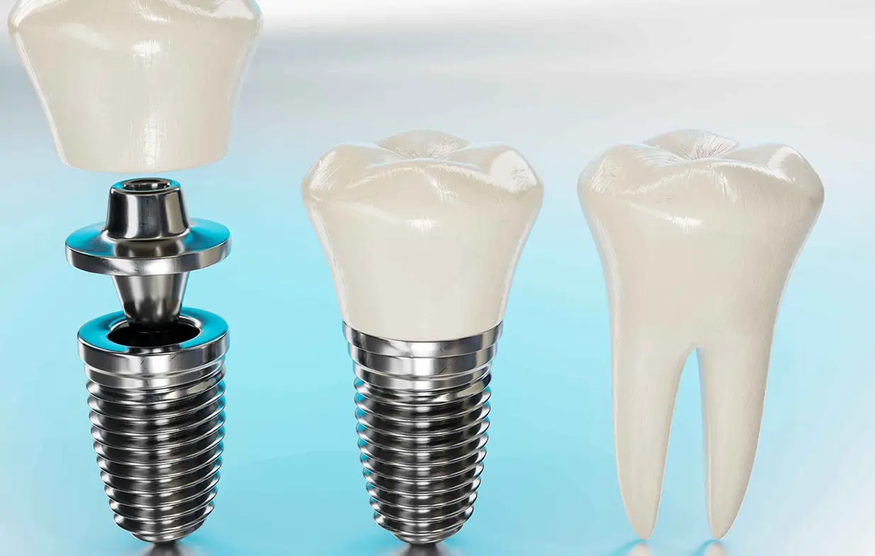 خرید پایه ایمپلنت 1 خرید پایه ایمپلنت